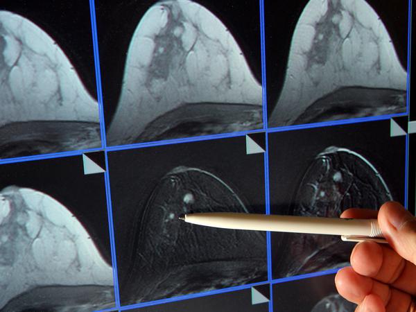 Auf einer Bildschirmdarstellung einer Magnetresonanz-Mammographie ist ein winziger Tumor in der Brust einer Patientin zu sehen. 