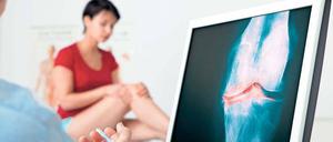 Die Deutsche Rheuma-Liga geht laut Gesundheitsministerium davon aus, dass 0,5 bis 0.8 Prozent der Bevölkerung an einer rheumatoiden Arthritis leiden. 